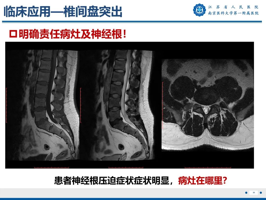 影像PPT - 【PPT】Bertolotti 综合征-37