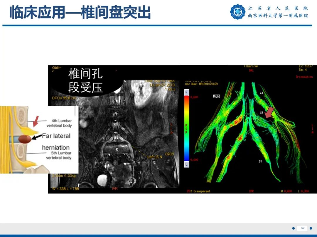 影像PPT - 【PPT】Bertolotti 综合征-39