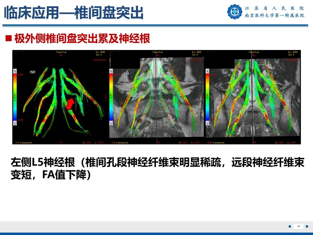 影像PPT - 【PPT】Bertolotti 综合征-41
