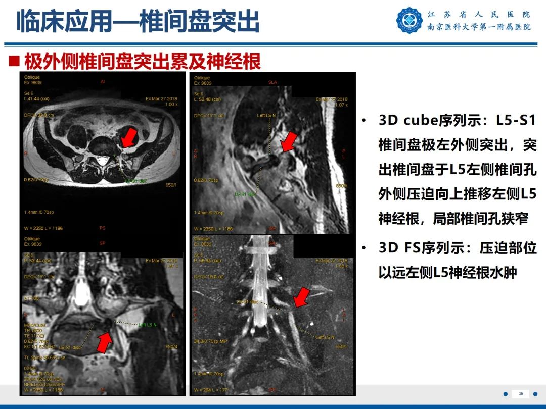 影像PPT - 【PPT】Bertolotti 综合征-40