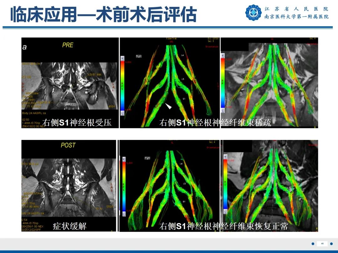 影像PPT - 【PPT】Bertolotti 综合征-42