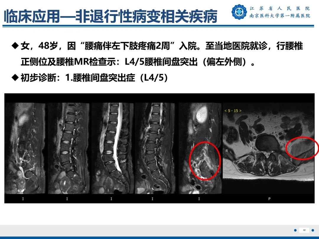 影像PPT - 【PPT】Bertolotti 综合征-43