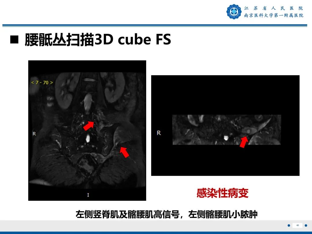 影像PPT - 【PPT】Bertolotti 综合征-44