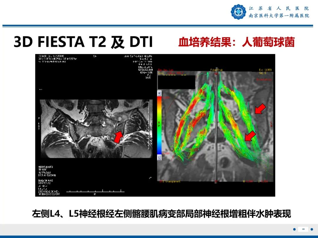 影像PPT - 【PPT】Bertolotti 综合征-45
