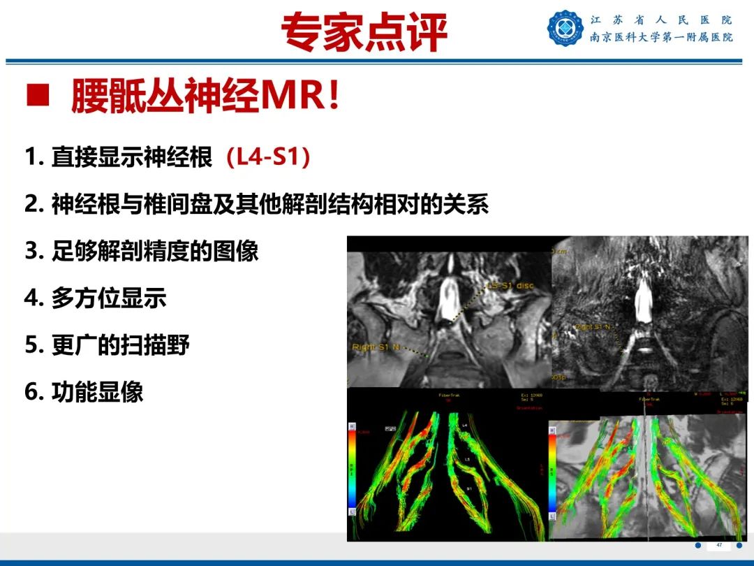 影像PPT - 【PPT】Bertolotti 综合征-48