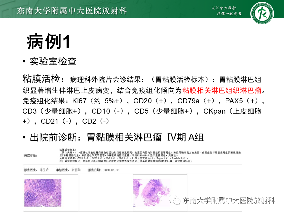 影像PPT - 【PPT】胃黏膜相关淋巴组织(MALT)淋巴瘤-3 影像PPT - 【PPT】胃黏膜相关淋巴组织(MALT)淋巴瘤-3