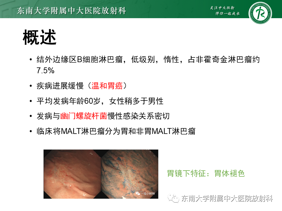 影像PPT - 【PPT】胃黏膜相关淋巴组织(MALT)淋巴瘤-5 影像PPT - 【PPT】胃黏膜相关淋巴组织(MALT)淋巴瘤-5