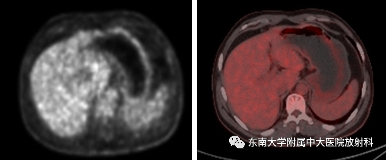 影像PPT - 【PPT】胃黏膜相关淋巴组织(MALT)淋巴瘤-2 影像PPT - 【PPT】胃黏膜相关淋巴组织(MALT)淋巴瘤-2