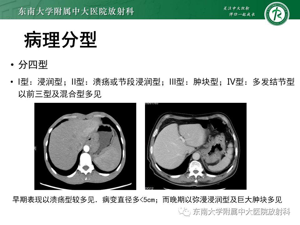 影像PPT - 【PPT】胃黏膜相关淋巴组织(MALT)淋巴瘤-9 影像PPT - 【PPT】胃黏膜相关淋巴组织(MALT)淋巴瘤-9