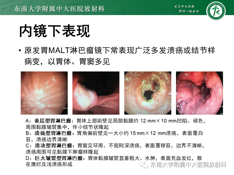 影像PPT - 【PPT】胃黏膜相关淋巴组织(MALT)淋巴瘤-12 影像PPT - 【PPT】胃黏膜相关淋巴组织(MALT)淋巴瘤-12
