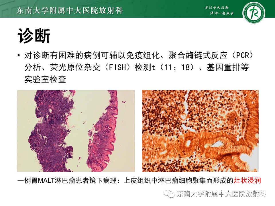 影像PPT - 【PPT】胃黏膜相关淋巴组织(MALT)淋巴瘤-13 影像PPT - 【PPT】胃黏膜相关淋巴组织(MALT)淋巴瘤-13