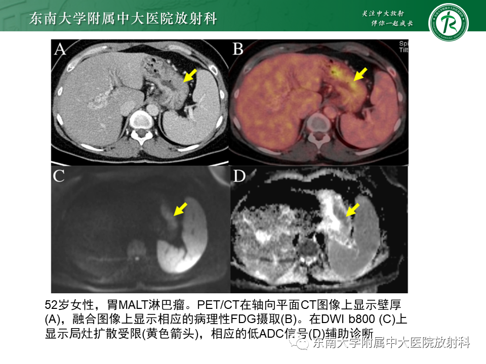 影像PPT - 【PPT】胃黏膜相关淋巴组织(MALT)淋巴瘤-17 影像PPT - 【PPT】胃黏膜相关淋巴组织(MALT)淋巴瘤-17