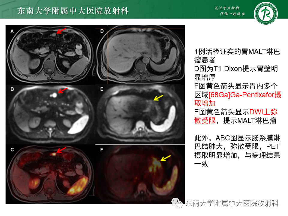 影像PPT - 【PPT】胃黏膜相关淋巴组织(MALT)淋巴瘤-19 影像PPT - 【PPT】胃黏膜相关淋巴组织(MALT)淋巴瘤-19
