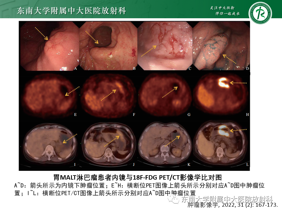 影像PPT - 【PPT】胃黏膜相关淋巴组织(MALT)淋巴瘤-20 影像PPT - 【PPT】胃黏膜相关淋巴组织(MALT)淋巴瘤-20