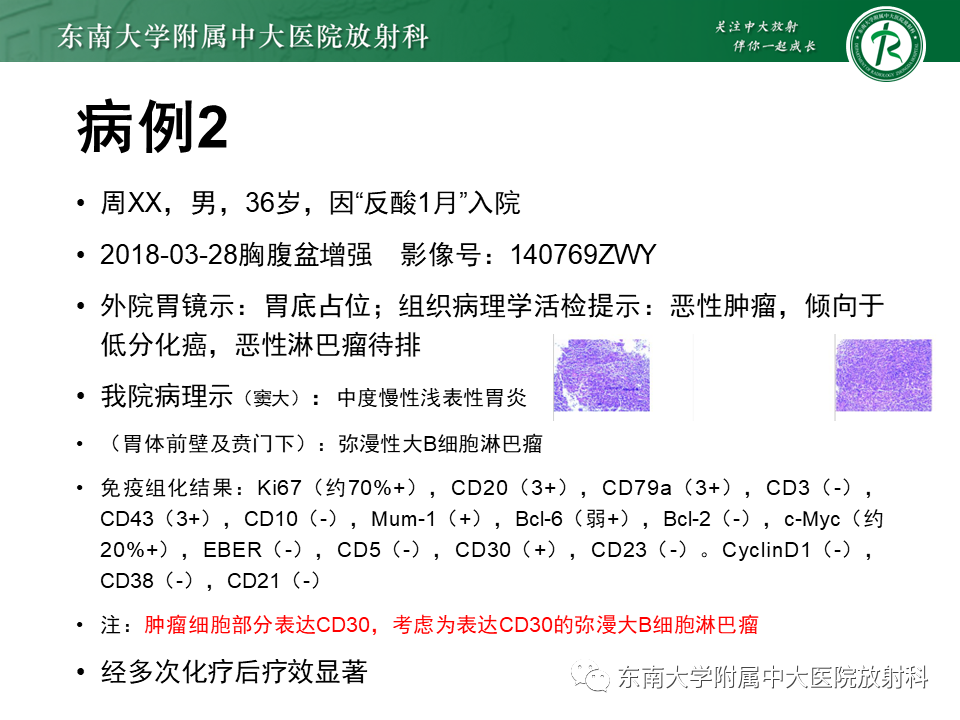 影像PPT - 【PPT】胃黏膜相关淋巴组织(MALT)淋巴瘤-23 影像PPT - 【PPT】胃黏膜相关淋巴组织(MALT)淋巴瘤-23