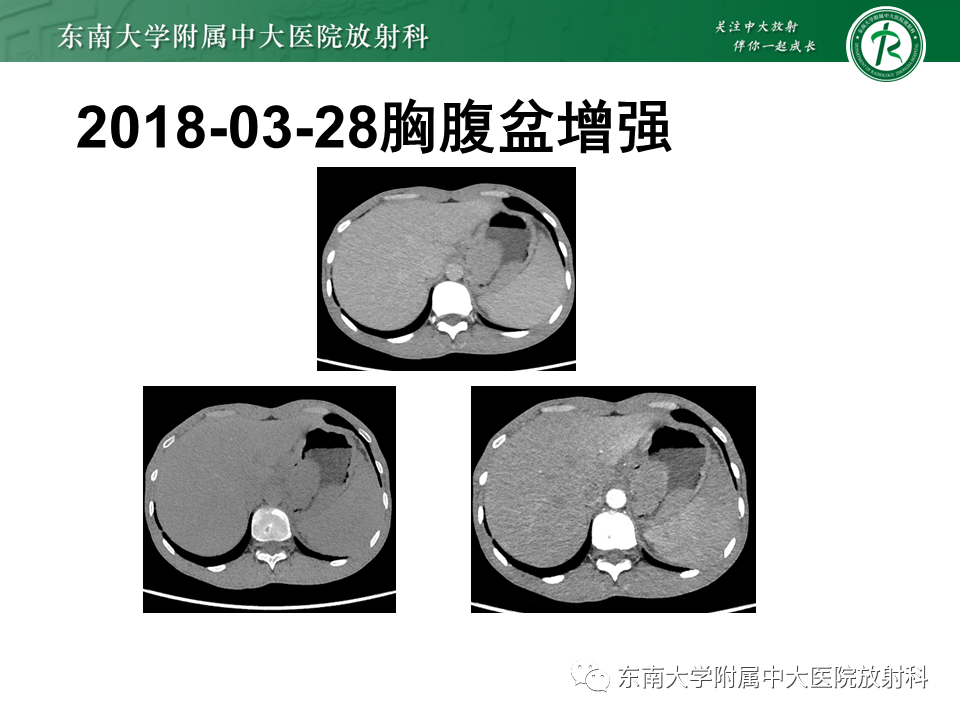 影像PPT - 【PPT】胃黏膜相关淋巴组织(MALT)淋巴瘤-24 影像PPT - 【PPT】胃黏膜相关淋巴组织(MALT)淋巴瘤-24