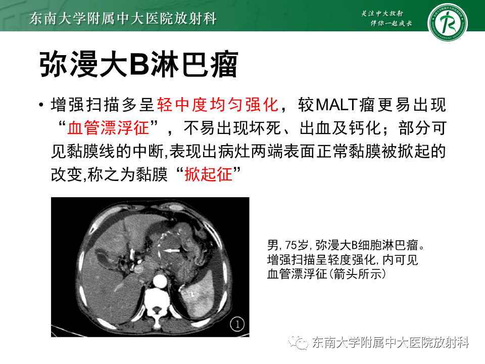 影像PPT - 【PPT】胃黏膜相关淋巴组织(MALT)淋巴瘤-26 影像PPT - 【PPT】胃黏膜相关淋巴组织(MALT)淋巴瘤-26