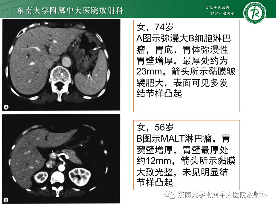 影像PPT - 【PPT】胃黏膜相关淋巴组织(MALT)淋巴瘤-27 影像PPT - 【PPT】胃黏膜相关淋巴组织(MALT)淋巴瘤-27