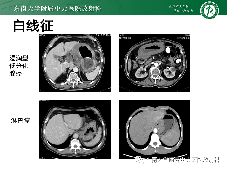 影像PPT - 【PPT】胃黏膜相关淋巴组织(MALT)淋巴瘤-30 影像PPT - 【PPT】胃黏膜相关淋巴组织(MALT)淋巴瘤-30