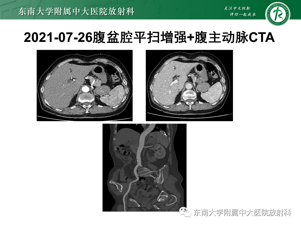 影像PPT - 【PPT】胃黏膜相关淋巴组织(MALT)淋巴瘤-32 影像PPT - 【PPT】胃黏膜相关淋巴组织(MALT)淋巴瘤-32
