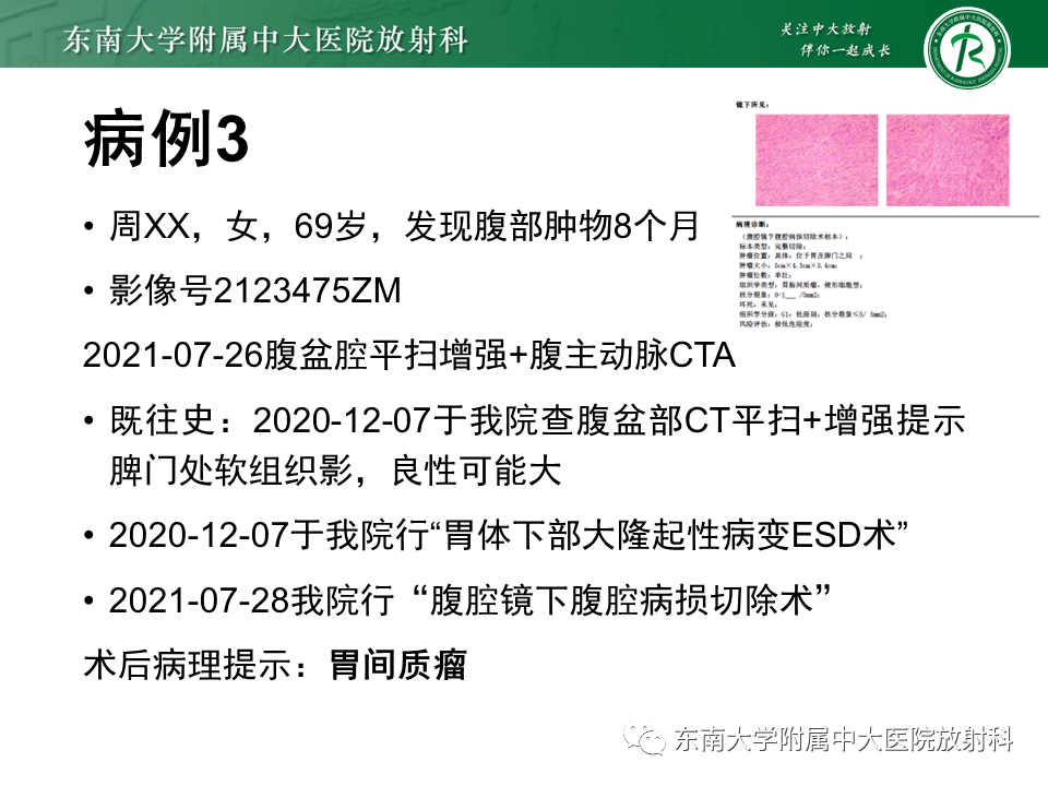 影像PPT - 【PPT】胃黏膜相关淋巴组织(MALT)淋巴瘤-31 影像PPT - 【PPT】胃黏膜相关淋巴组织(MALT)淋巴瘤-31