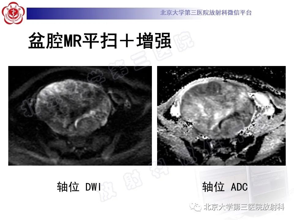 影像PPT - 【PPT】卵巢卵黄囊瘤/内胚窦瘤-5
