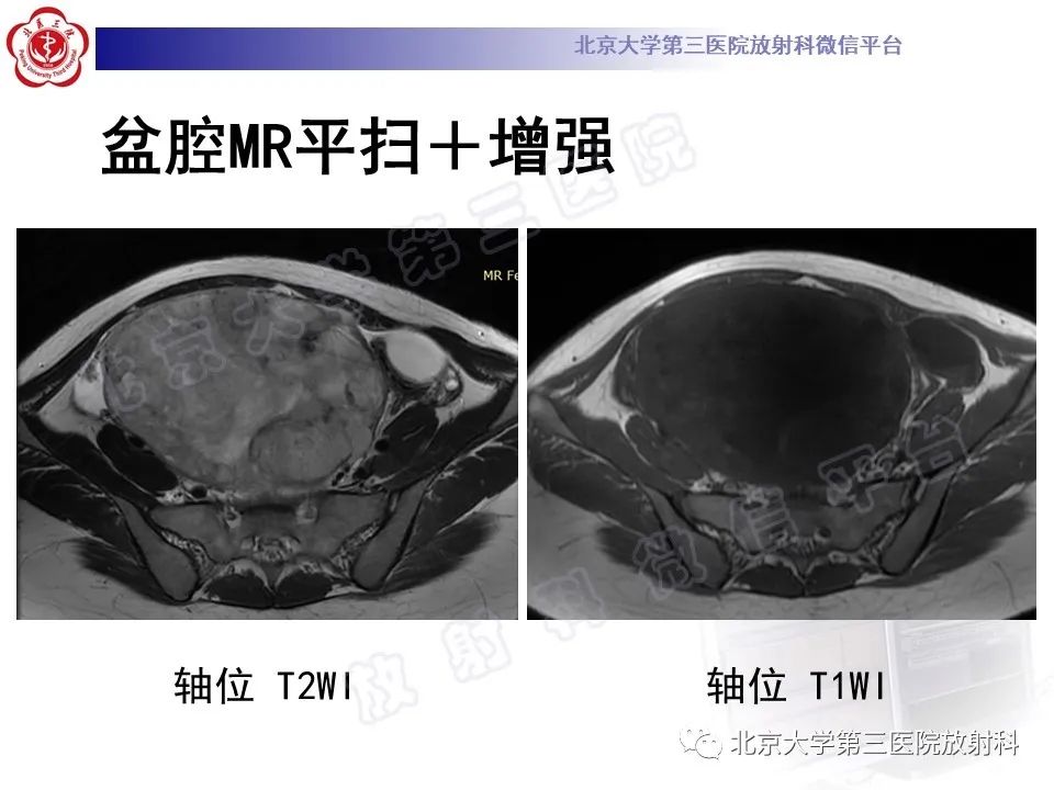 影像PPT - 【PPT】卵巢卵黄囊瘤/内胚窦瘤-3
