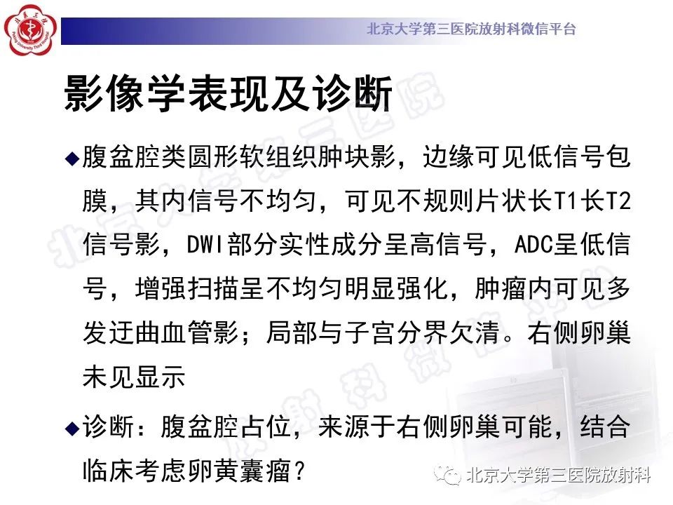 影像PPT - 【PPT】卵巢卵黄囊瘤/内胚窦瘤-7