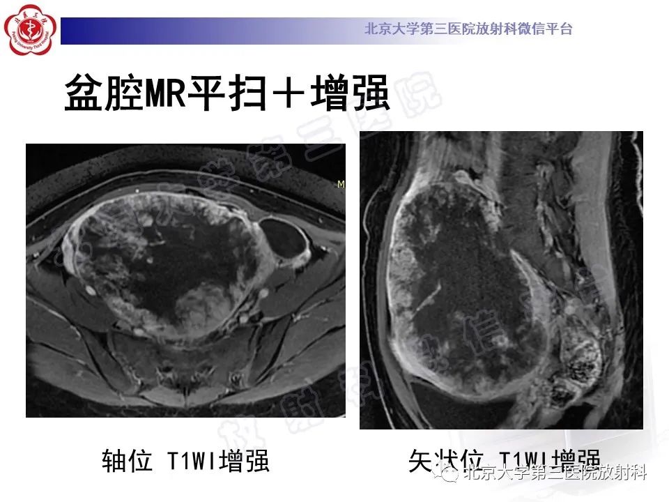 影像PPT - 【PPT】卵巢卵黄囊瘤/内胚窦瘤-6