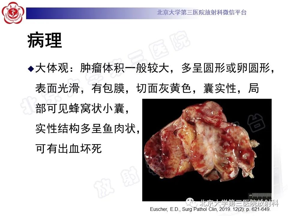影像PPT - 【PPT】卵巢卵黄囊瘤/内胚窦瘤-11