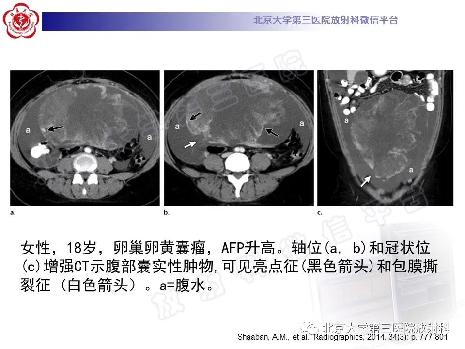 影像PPT - 【PPT】卵巢卵黄囊瘤/内胚窦瘤-17
