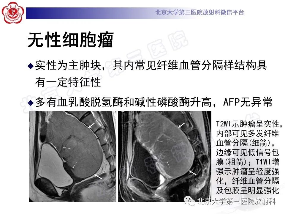 影像PPT - 【PPT】卵巢卵黄囊瘤/内胚窦瘤-19
