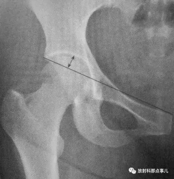 影像PPT - 骨盆和髋关节的X线评估及测量-7 影像PPT - 骨盆和髋关节的X线评估及测量-7