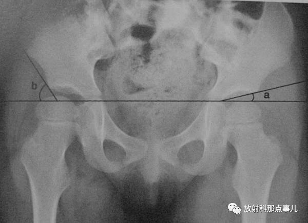 影像PPT - 骨盆和髋关节的X线评估及测量-9 影像PPT - 骨盆和髋关节的X线评估及测量-9