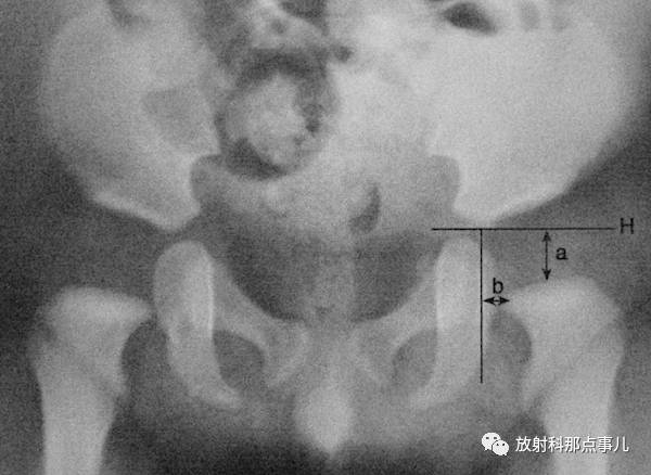 影像PPT - 骨盆和髋关节的X线评估及测量-13 影像PPT - 骨盆和髋关节的X线评估及测量-13