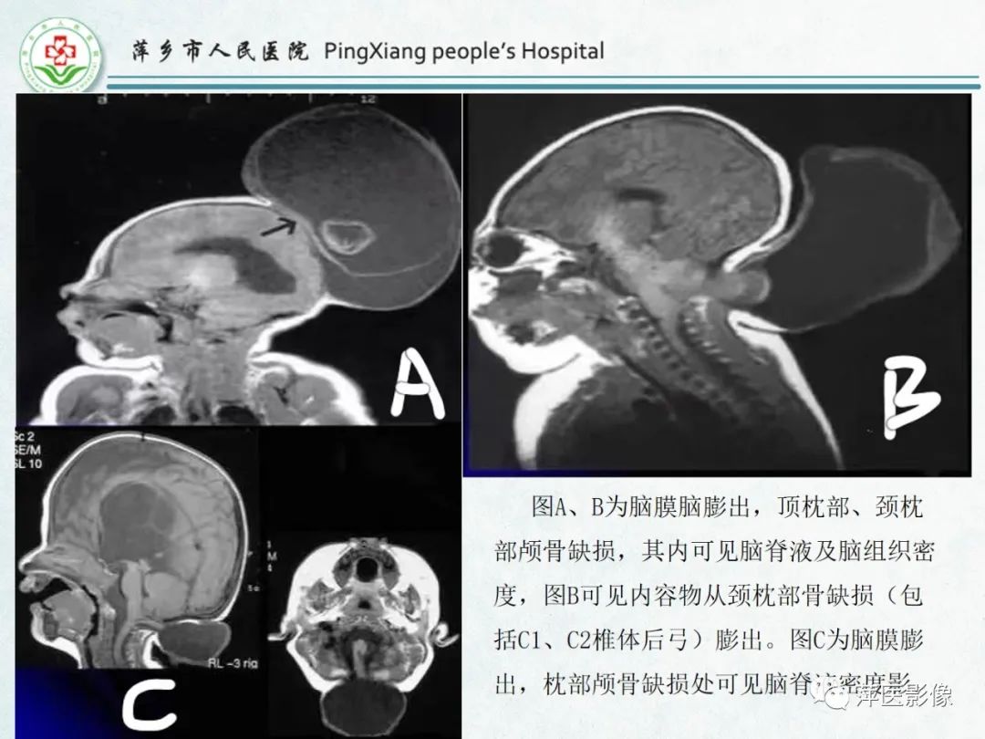 影像PPT - 【PPT】颅脑先天性畸形及发育异常的影像诊断-7