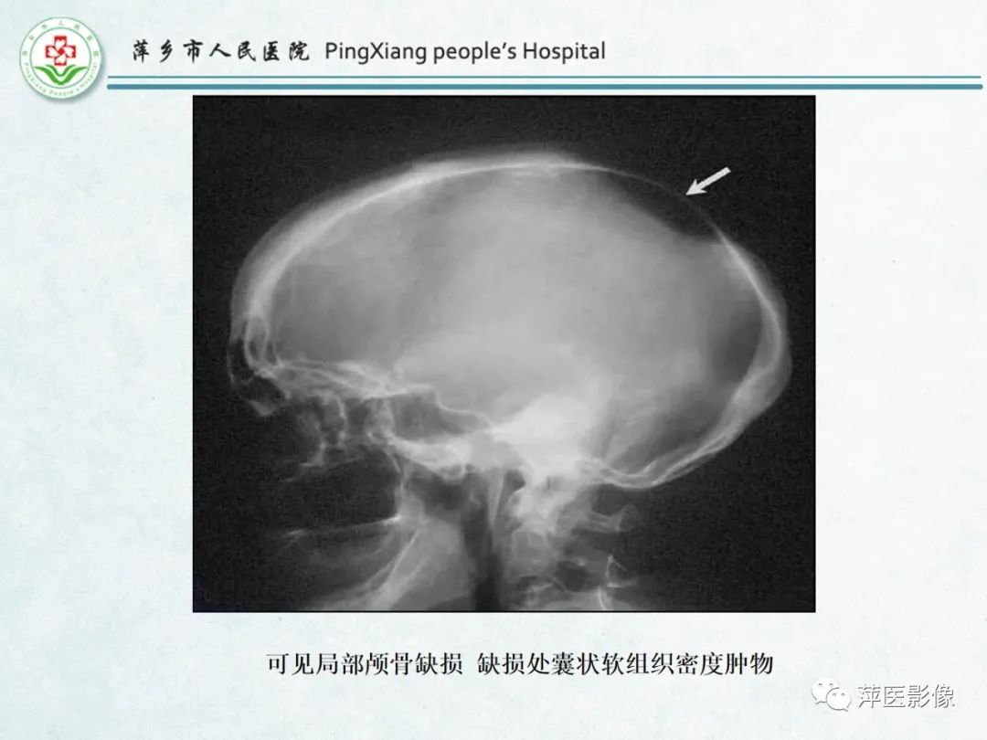 影像PPT - 【PPT】颅脑先天性畸形及发育异常的影像诊断-6
