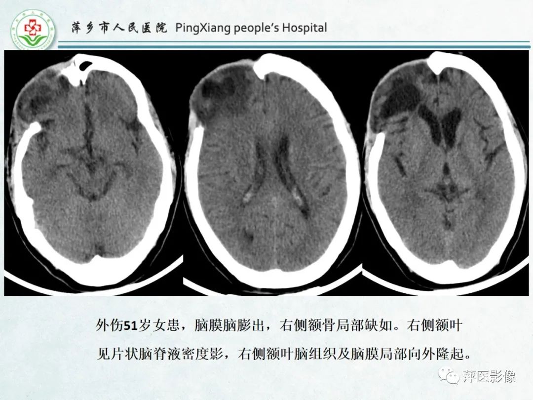 影像PPT - 【PPT】颅脑先天性畸形及发育异常的影像诊断-8