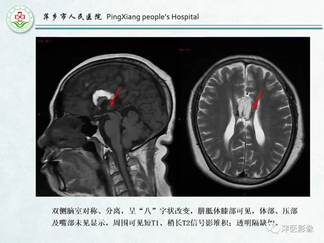 影像PPT - 【PPT】颅脑先天性畸形及发育异常的影像诊断-13