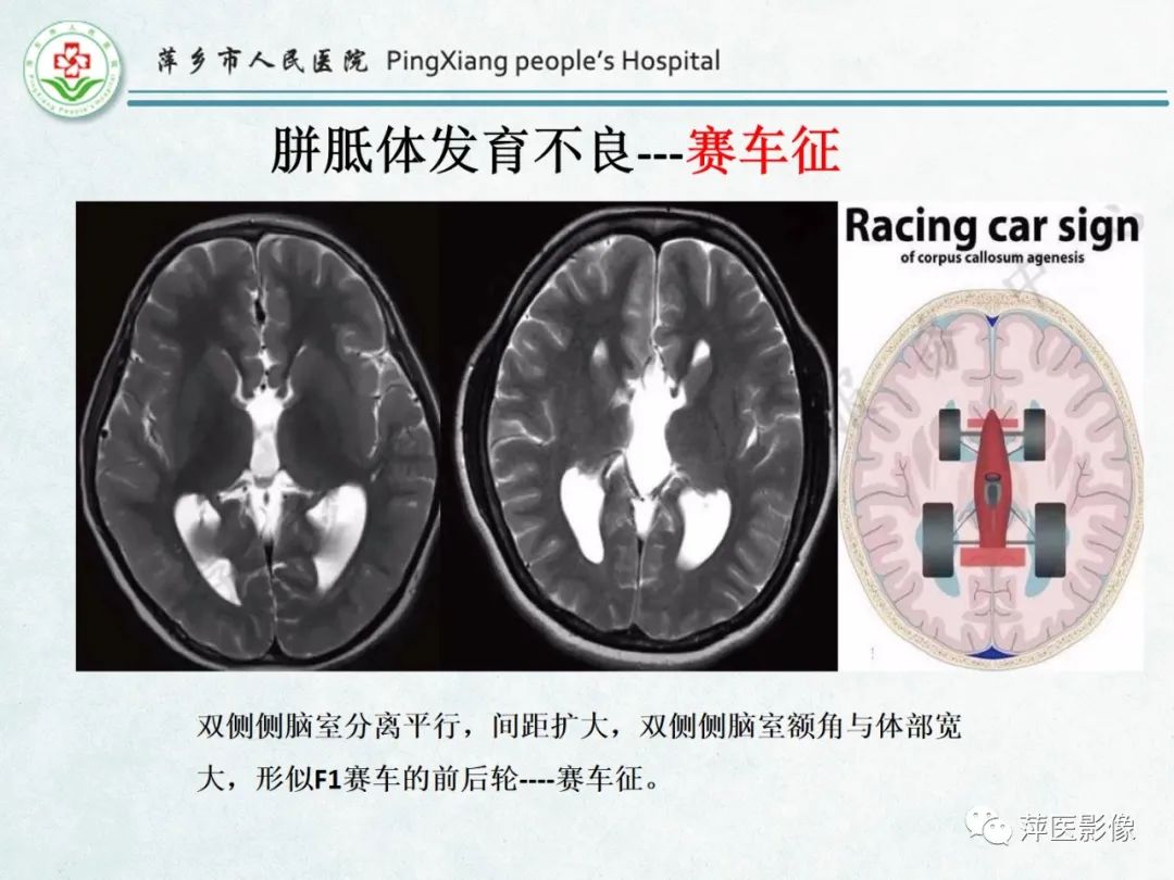 影像PPT - 【PPT】颅脑先天性畸形及发育异常的影像诊断-14