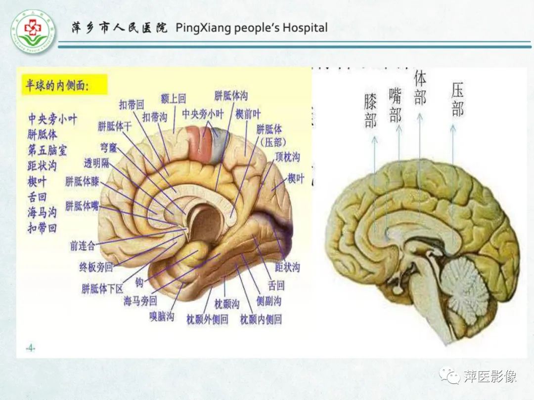 影像PPT - 【PPT】颅脑先天性畸形及发育异常的影像诊断-11