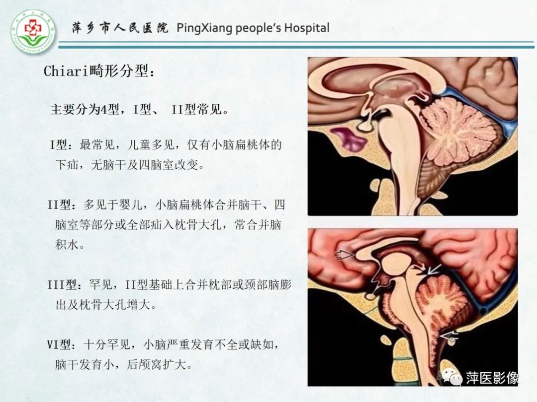 影像PPT - 【PPT】颅脑先天性畸形及发育异常的影像诊断-17