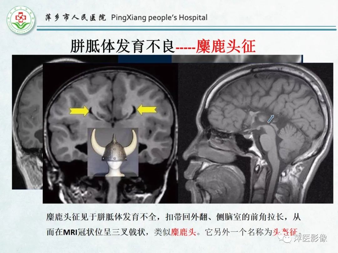 影像PPT - 【PPT】颅脑先天性畸形及发育异常的影像诊断-15