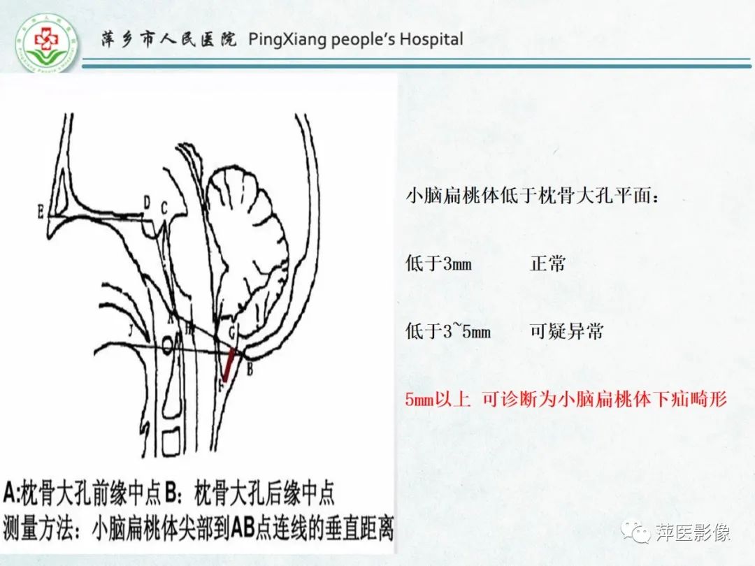 影像PPT - 【PPT】颅脑先天性畸形及发育异常的影像诊断-18