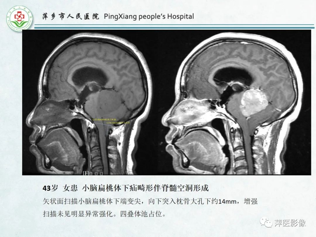 影像PPT - 【PPT】颅脑先天性畸形及发育异常的影像诊断-21