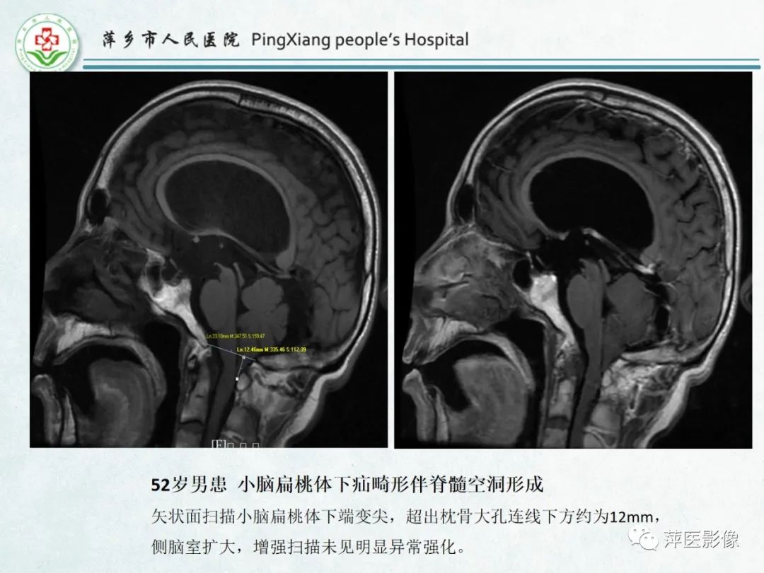 影像PPT - 【PPT】颅脑先天性畸形及发育异常的影像诊断-20