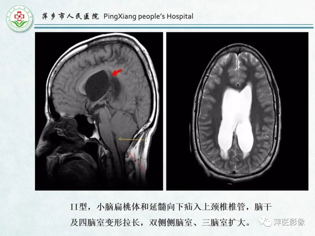 影像PPT - 【PPT】颅脑先天性畸形及发育异常的影像诊断-22