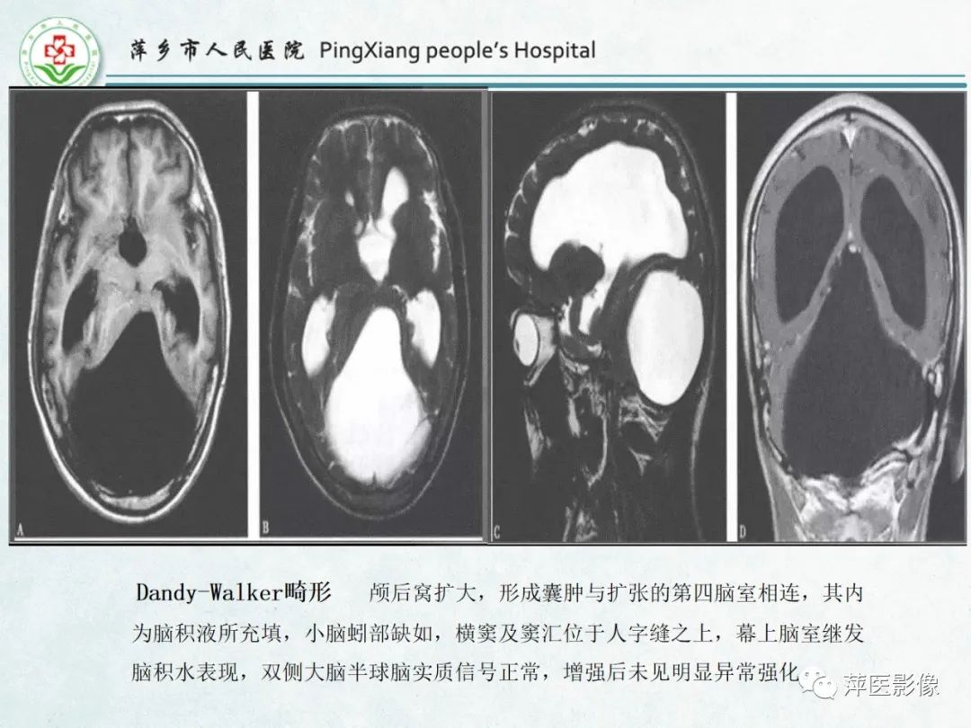 影像PPT - 【PPT】颅脑先天性畸形及发育异常的影像诊断-26
