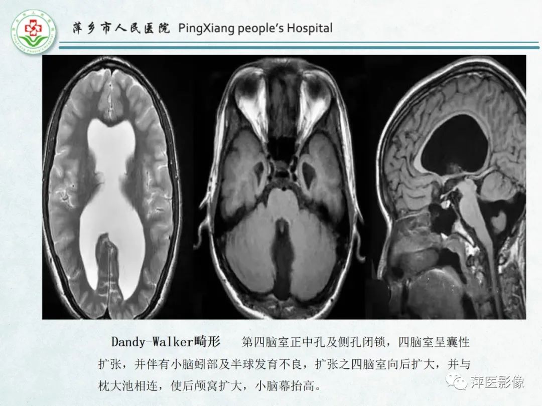 影像PPT - 【PPT】颅脑先天性畸形及发育异常的影像诊断-25