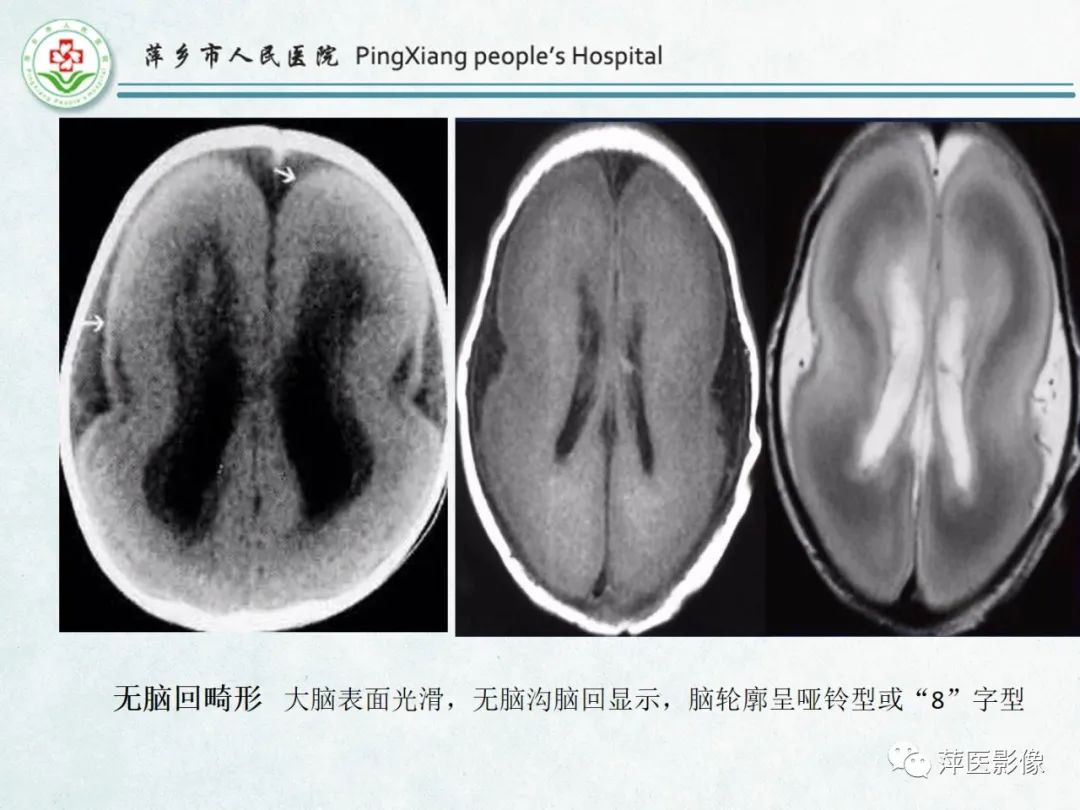 影像PPT - 【PPT】颅脑先天性畸形及发育异常的影像诊断-29